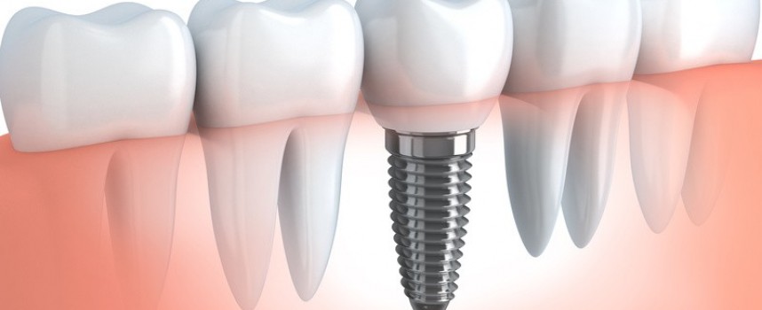 Qu’est-ce qu’un implant dentaire ?